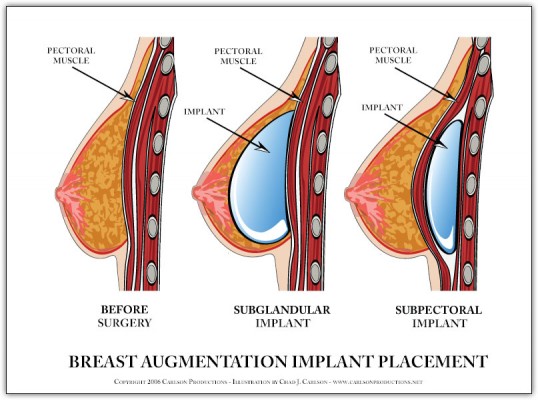 Diagrams Self Breast Massage Implants 113